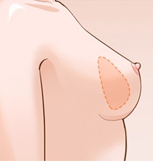 乳头内陷矫正